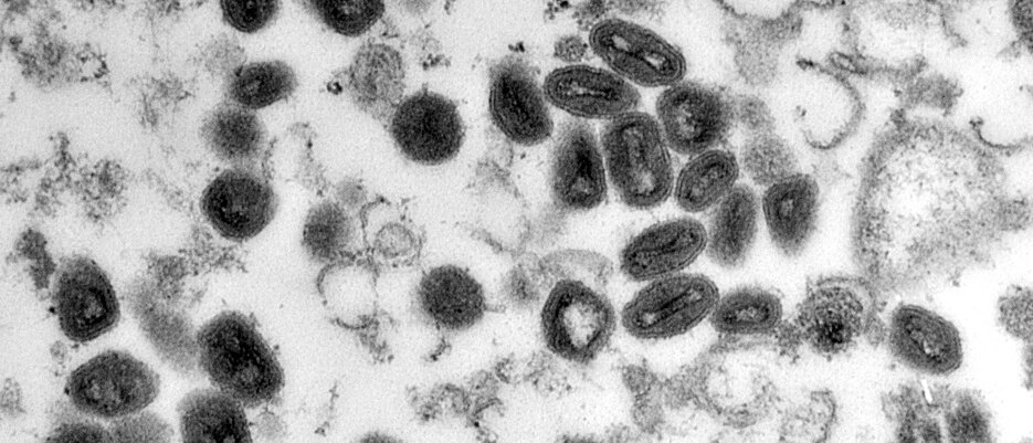 Pockenviren – hier unter dem Mikroskop – zählen zu den tödlichsten Krankheitserregern der Menschheitsgeschichte. Nicht ganz so gefährlich, aber dennoch beunruhigend ist der derzeitige Ausbruch der Affenpocken. 