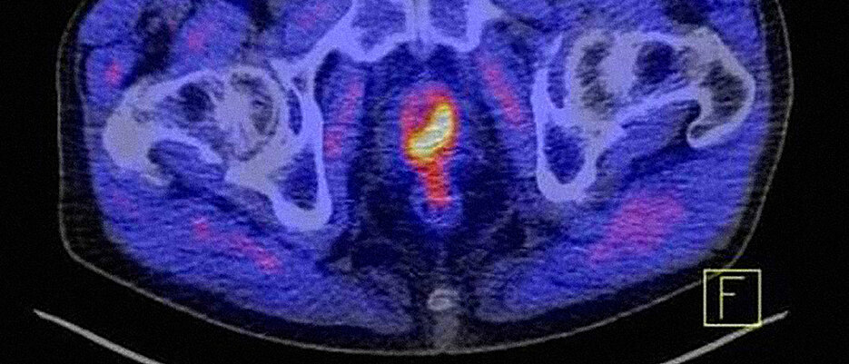 The German Cancer Aid will establish a junior research center in Würzburg to do cancer research (the picture shows a carcinoma of the prostate, yellow). (Photo: Würzburg University Hospital)