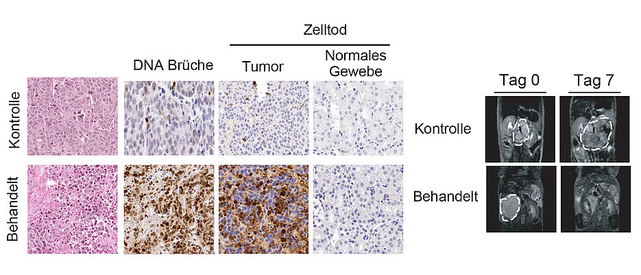 Das Konzept der zwei Züge auf einem Gleis in der biologischen Realität. Links sieht man mikroskopische Bilder von Tumor- und Normalgewebe, die zeigen, dass die Auslösung von Kollisionen zwischen dem Ablesen und der Verdoppelung der DNA zu Chrosomosomenbrüchen und Tod des Tumorgewebes führt, aber keine Effekte auf das benachbarte Normalgewebe hat. Rechts sind radiologische Aufnahmen, die zeigen, dass der Tumor nach relativ kurzer Behandlung zusammenbricht. Die Aufnahmen zeigen Neuroblastome. 